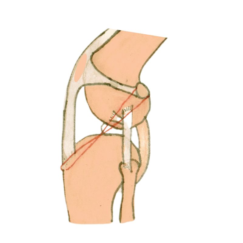 Lateral suture technique displayed on a drawing of a bone